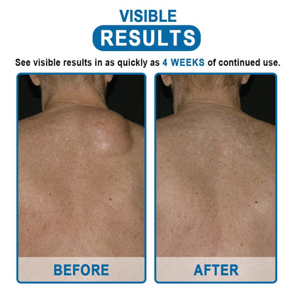 KISSHI™ Lipoma Removal Cream