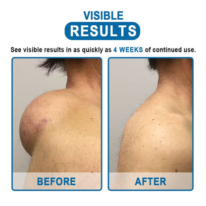 KISSHI™ Lipoma Removal Cream