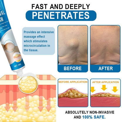 KISSHI™ Lipoma Removal Cream