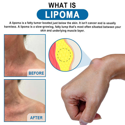 KISSHI™ Lipoma Removal Cream